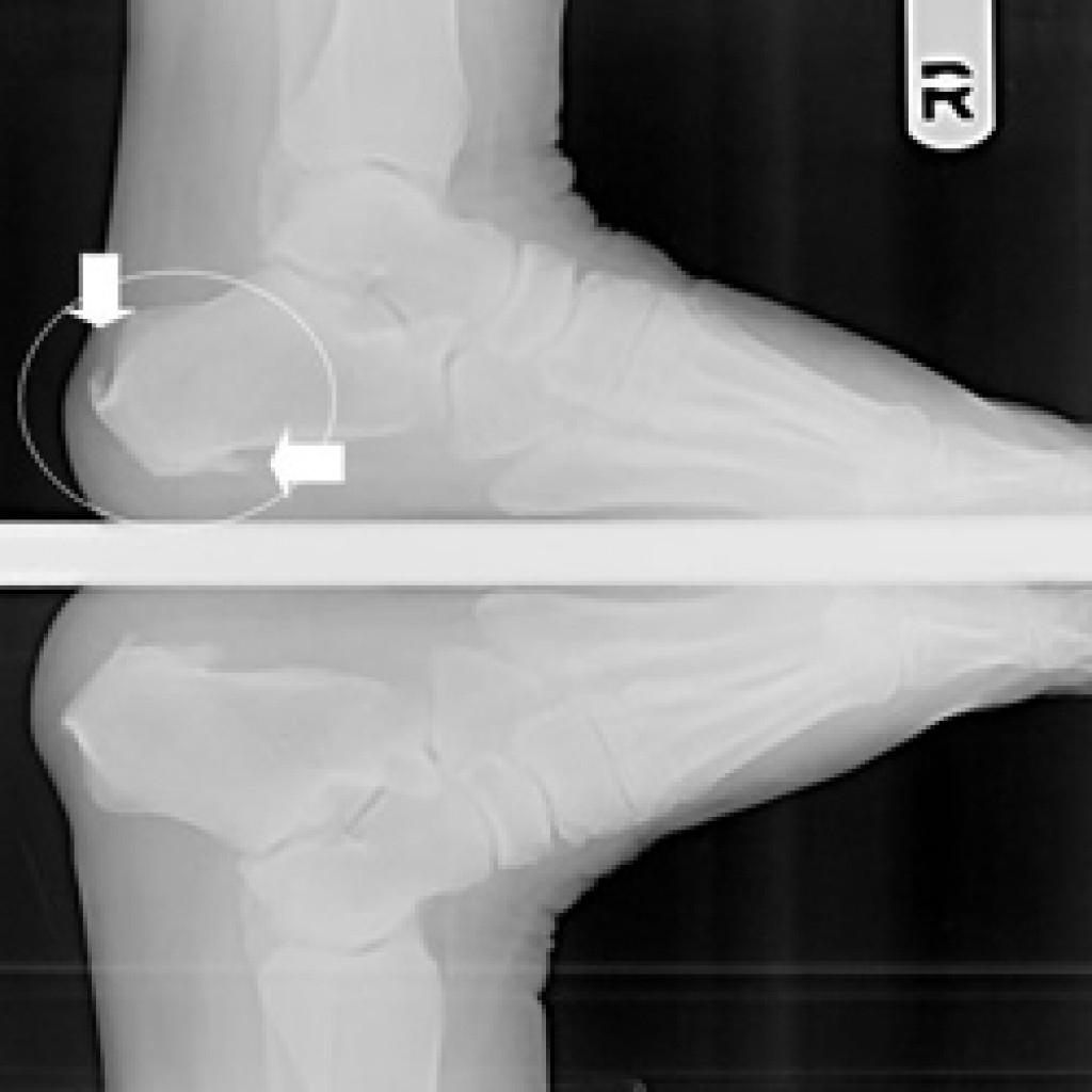 An image of a patient foot with a Jones Fracture