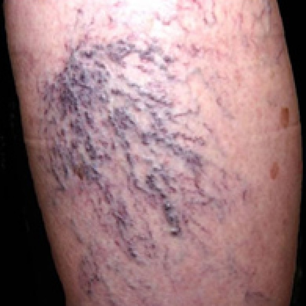 Spider Vein pre-treatment