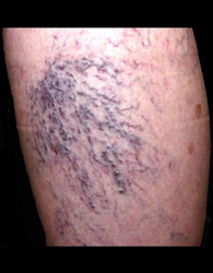 Spider Veins, Sprained Ankle Among Most Common Ailments 