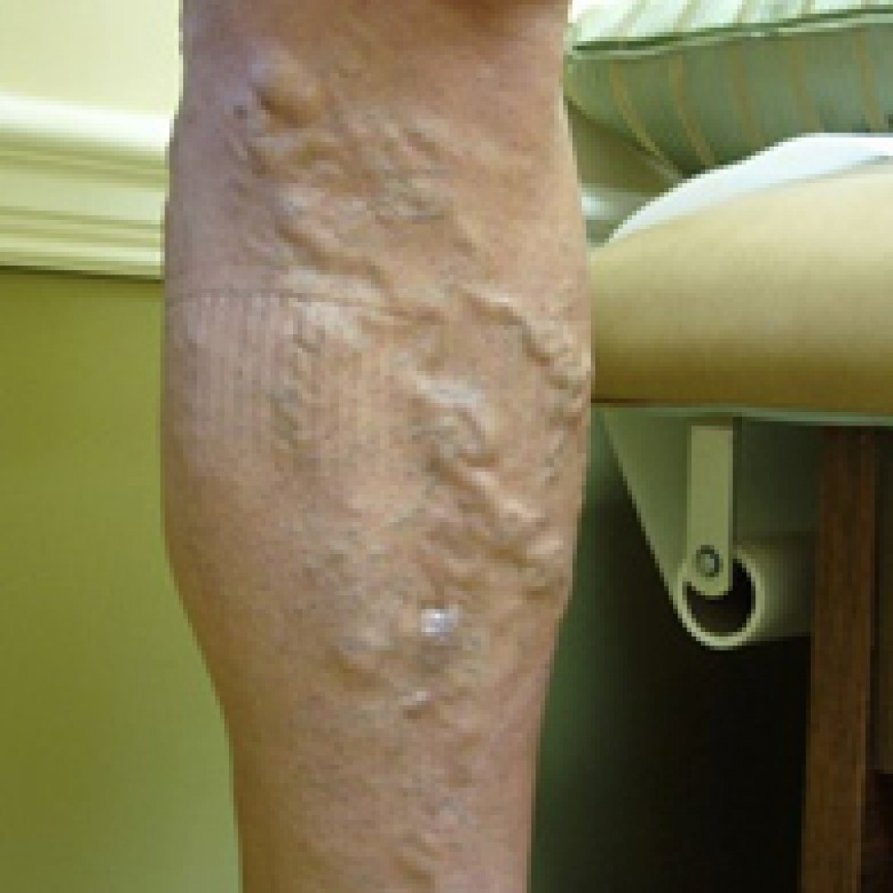COVID19 Causing Leg Swelling Boynton Beach Podiatrist