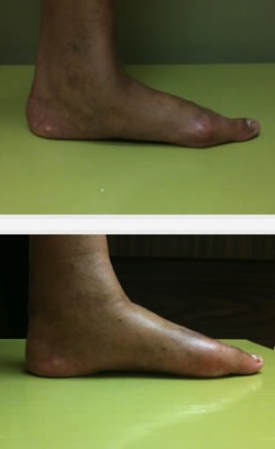 Flat Feet