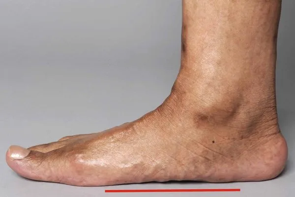 Flat Feet Conditions