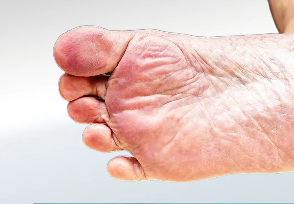 Toes and Feet Conditions