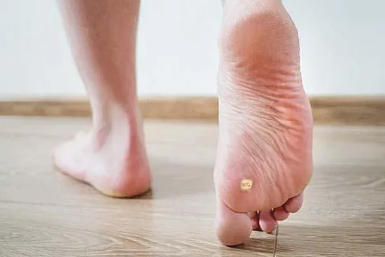 overview of Plantar Warts