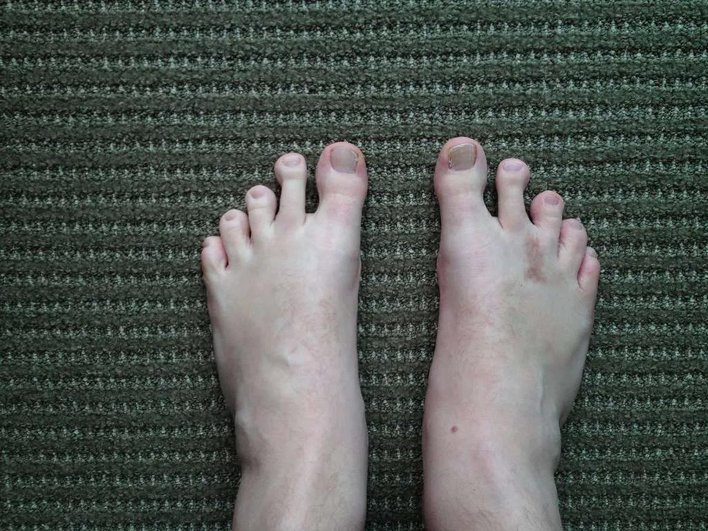 Morton’s Neuroma