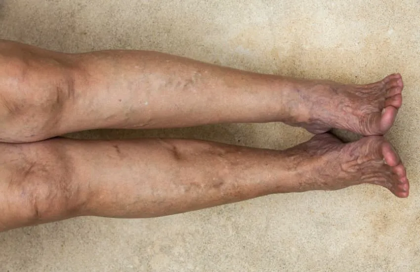 Venous Congestion and Leg Pain