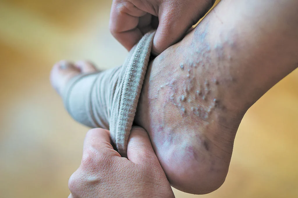 Medical Treatment for Varicose Veins