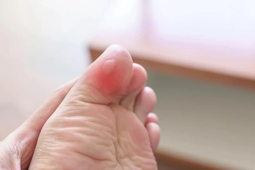 Preventing Blisters