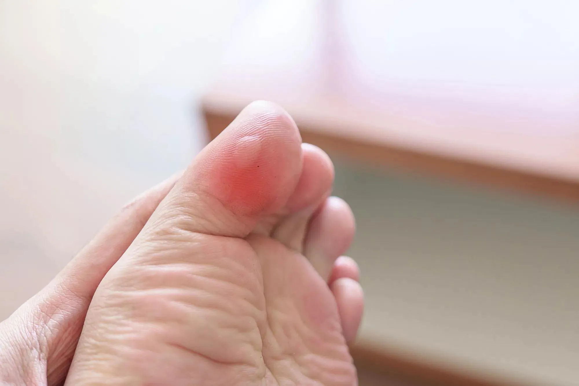 Preventing Blisters