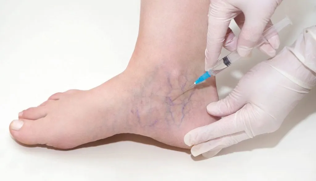 Benefits of Sclerotherapy Treatment