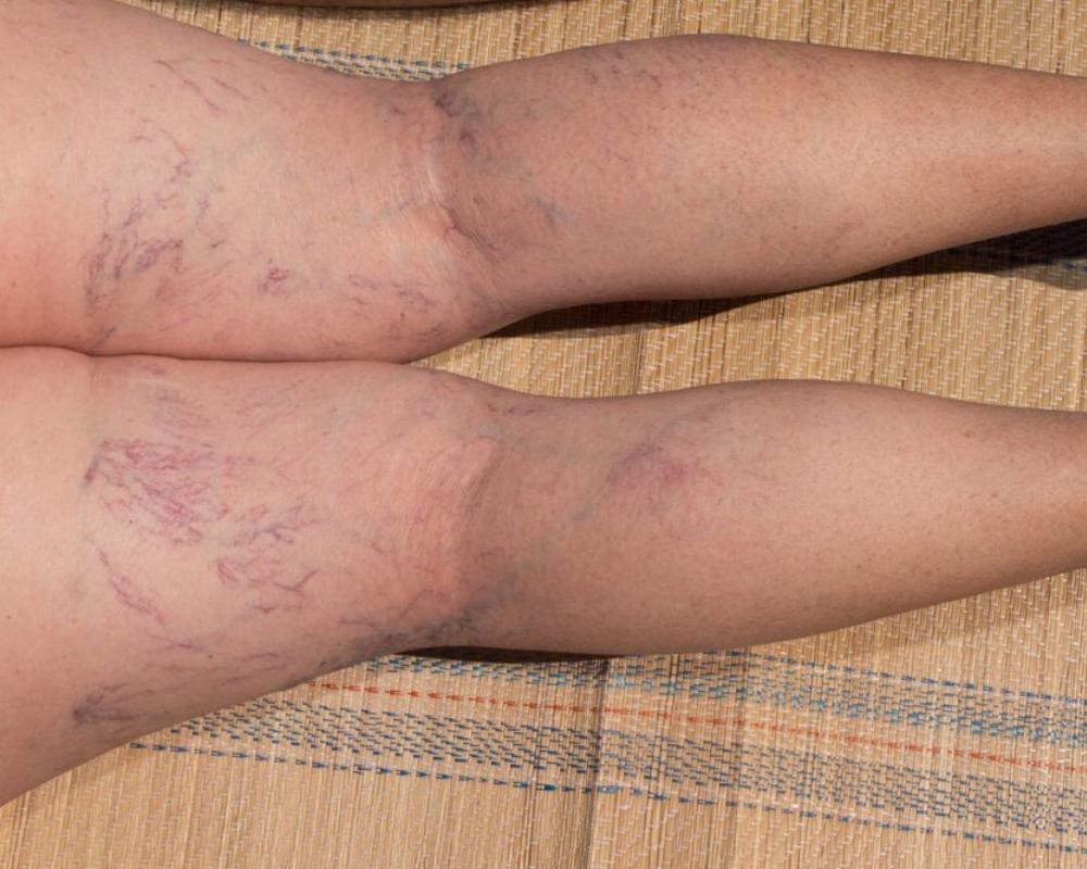 Prevent and Treat Spider Veins