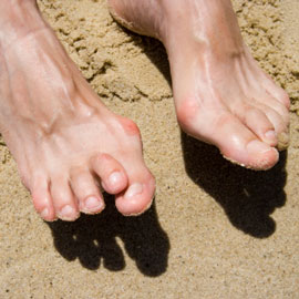 Visit the Podiatrist for Bunions and Plantar Fasciitis in Boca Raton