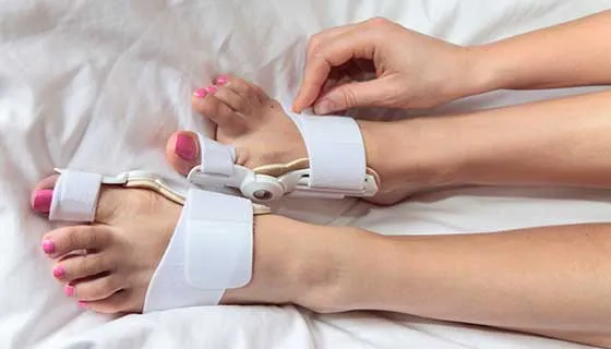 Myths about Bunion Surgery