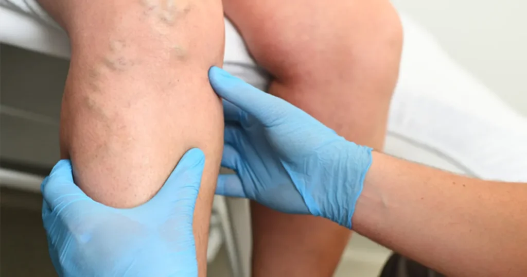 The Health Impact of Blood Clots