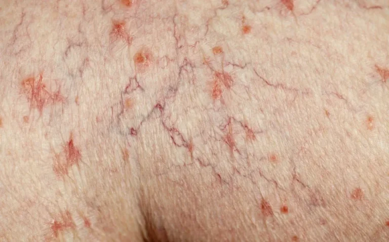 Foods for Varicose Veins and Spider Veins