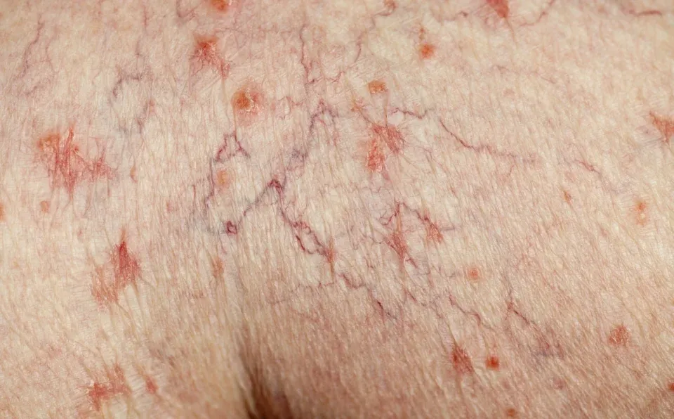 Foods for Varicose Veins and Spider Veins