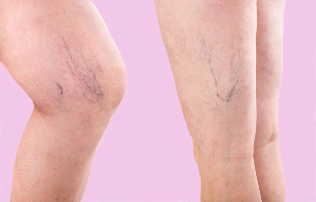 Vein Treatment during Pregnancy