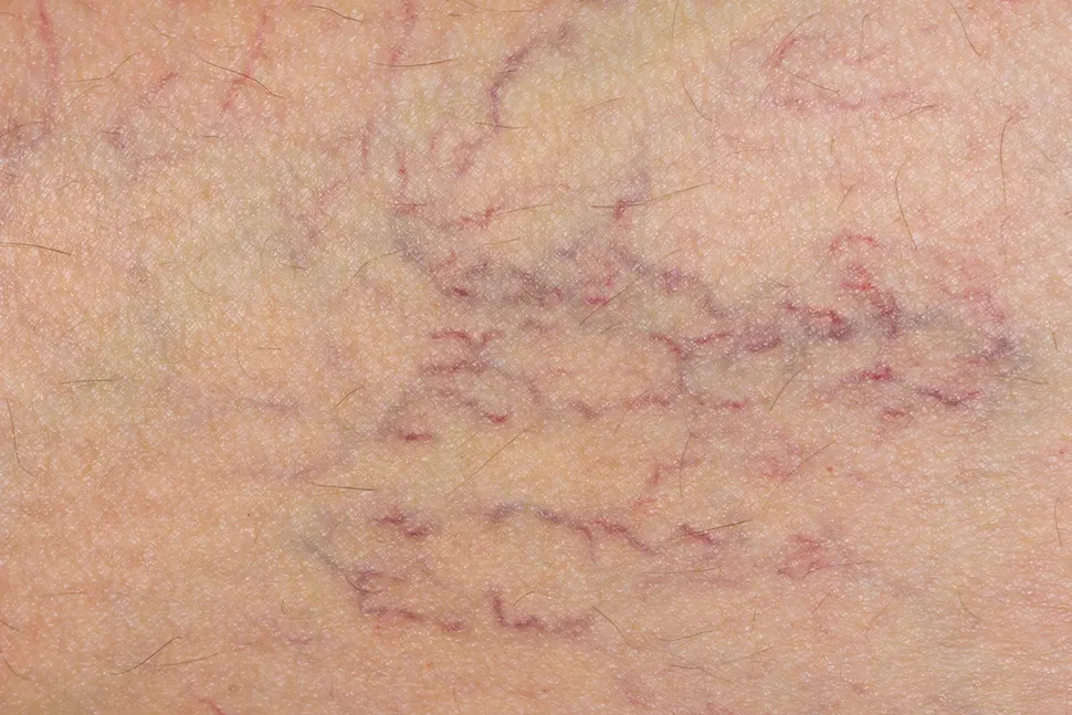 Myths about Spider and Varicose Veins