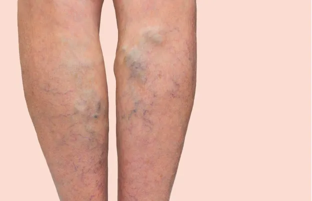 Varicose Vein Complications