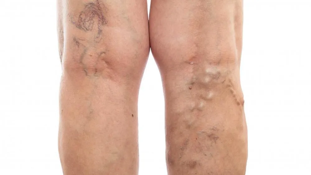 Vein Treatment for Legs