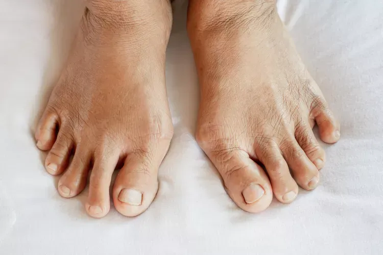 Foot Arthritis