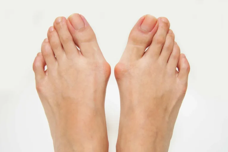 Understanding Bunions