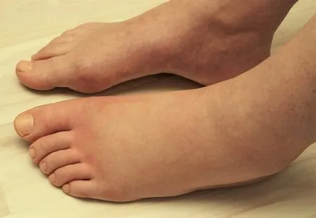 Inflammation in Feet and Ankles