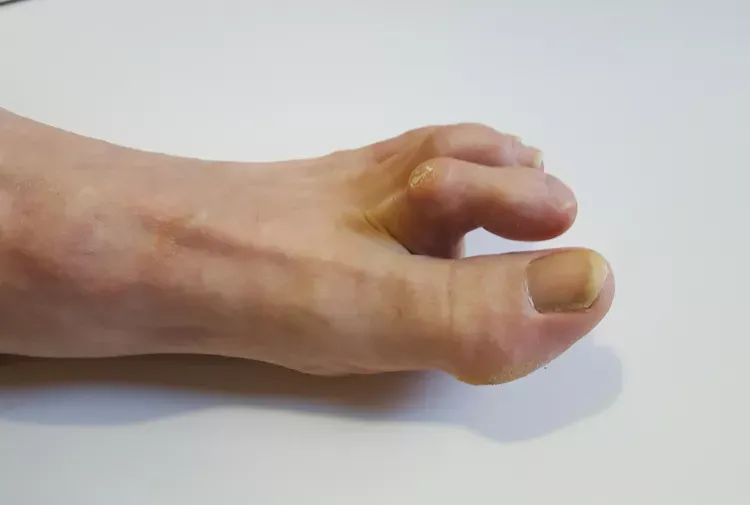 causes of hammertoes