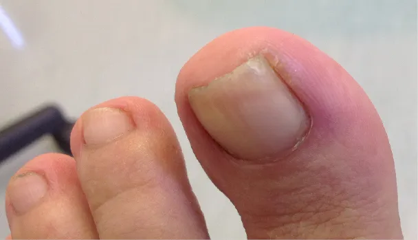 Causes of Ingrown Toenails