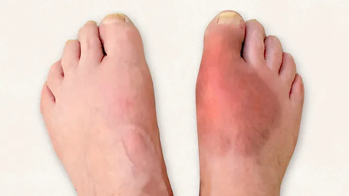 Nutrition, Inflammation, and Foot Pain