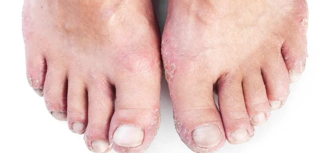 Skin Conditions of the Feet