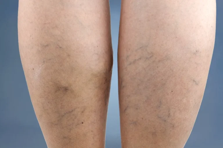 varicose veins