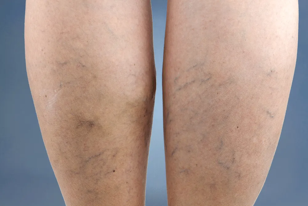 varicose veins