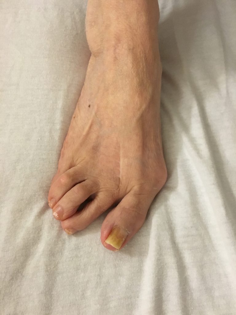 A Foot, Ankle & Leg Vein Center patient’s toe with yellow nails on a bed, displaying signs of needing bunion treatment.