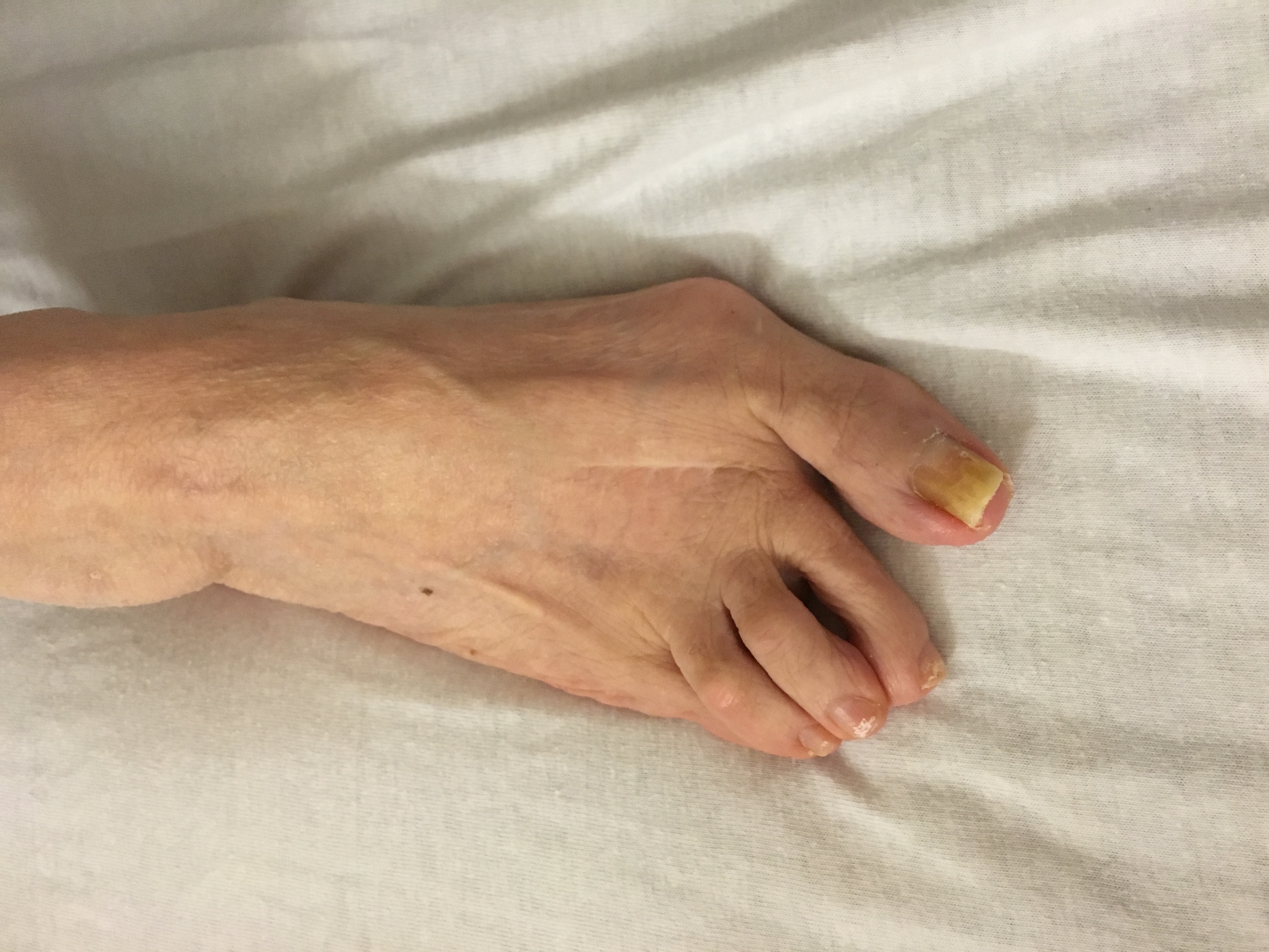 Symptoms and Signs That You Need Bunion Treatment Boynton Beach