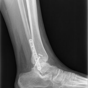 ankle fracture