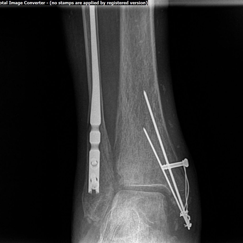 Jones Fractures Treatment