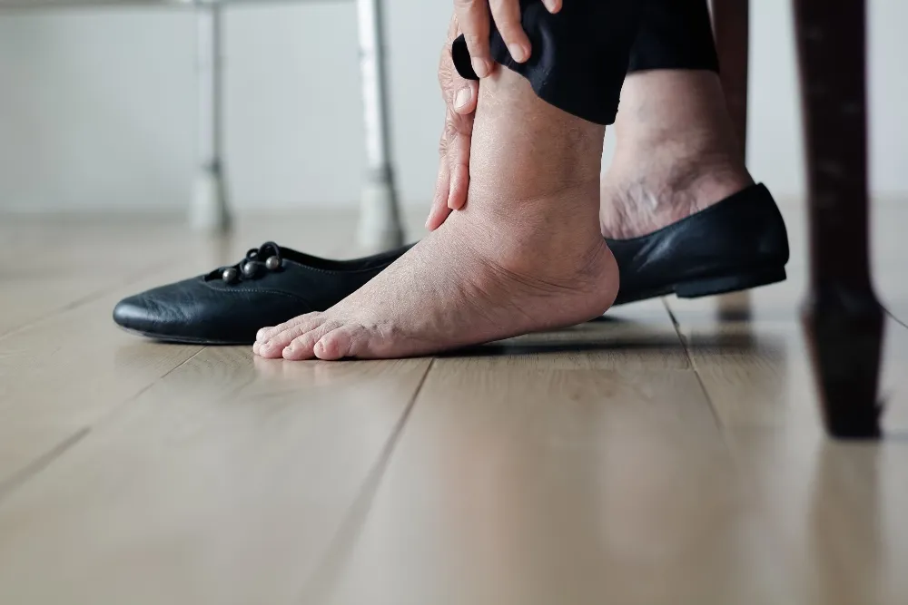How Obesity Affects Your Feet