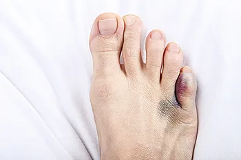 Symptoms of a Broken Toe