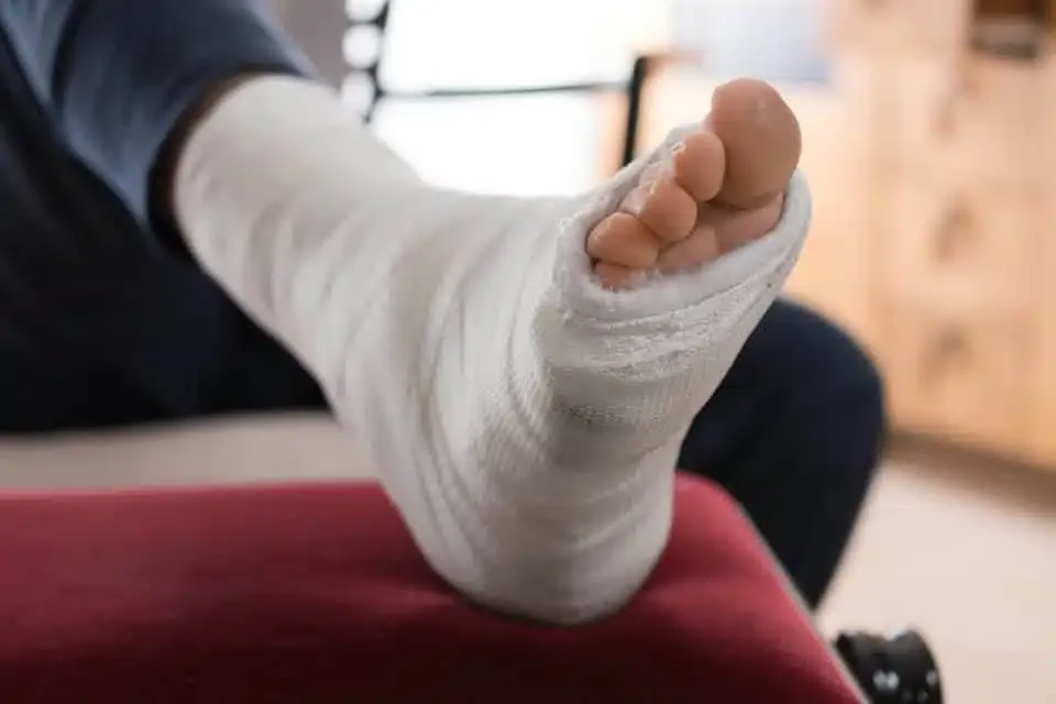 Treatment for a Broken Foot