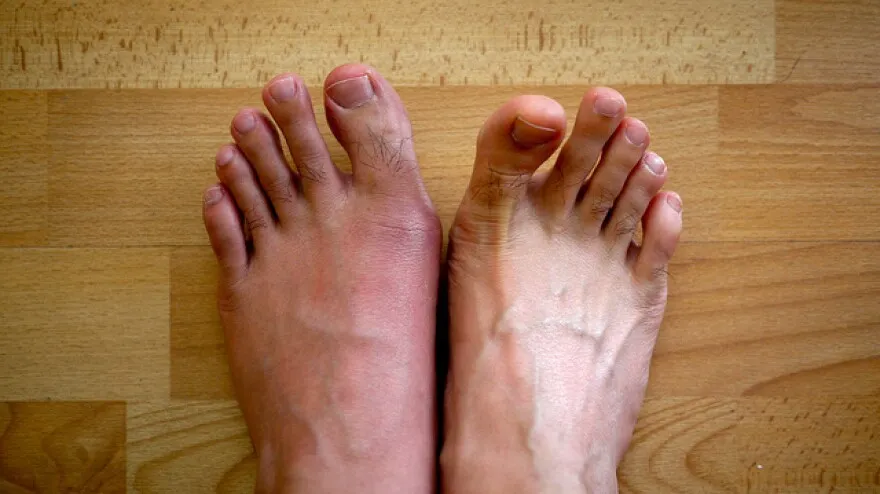 Everything You Need to Know About Gout