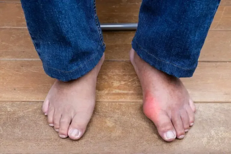 Gout in the Foot