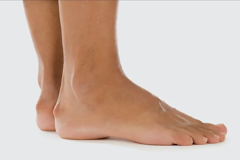 Heel Spurs