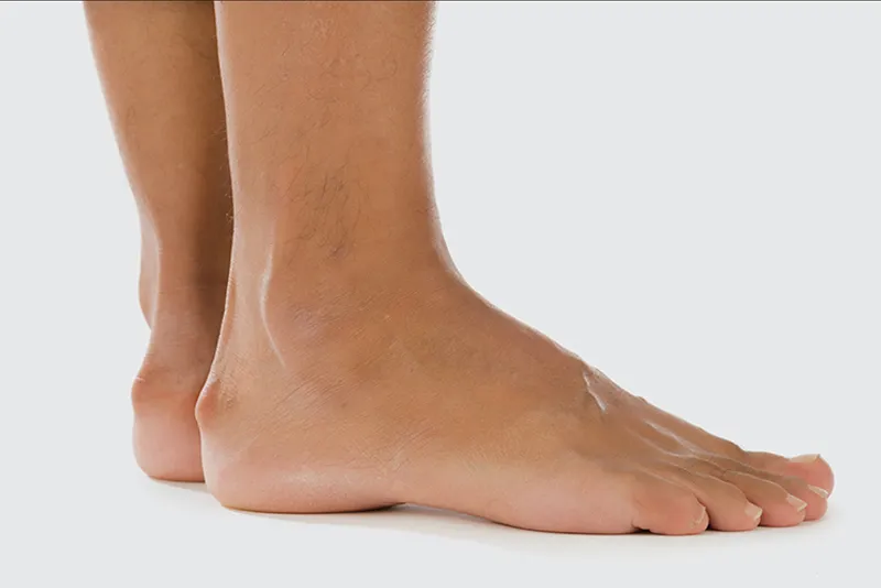 Heel Spurs
