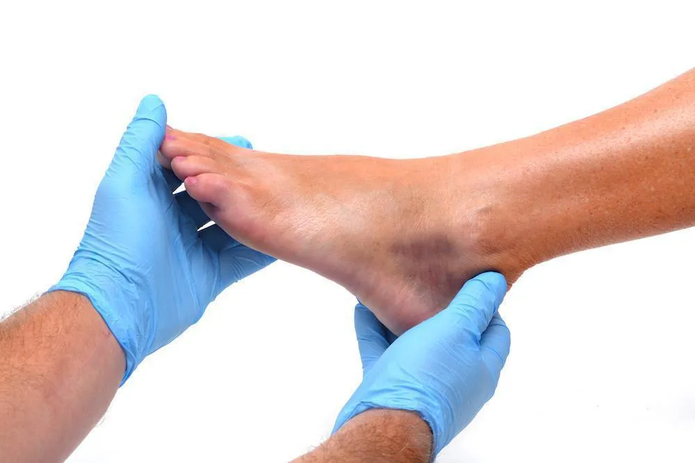 What is a Broken Ankle?