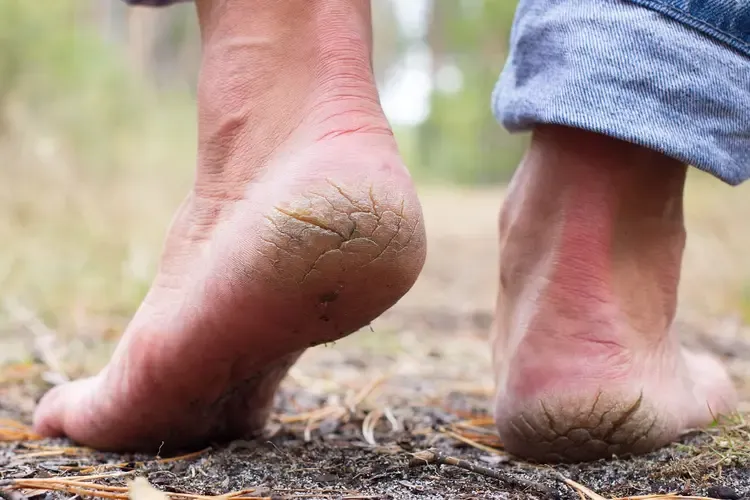 home remedy cracked heels