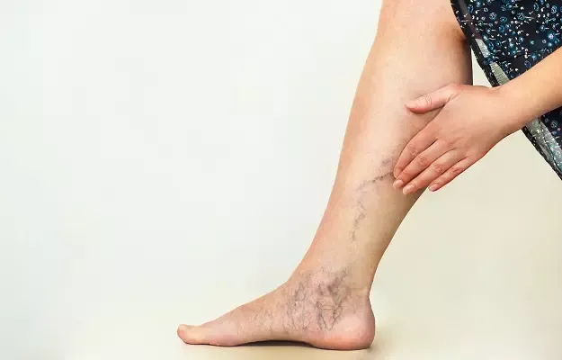 varicose veins during pregnancy