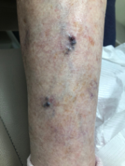 Bleeding Varicose Veins