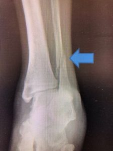 fibula fracture