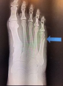 Tips to Prevent Foot Injuries when Playing Sports
